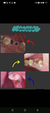 قلع جذور • طقم أسنان • علاج مجاني