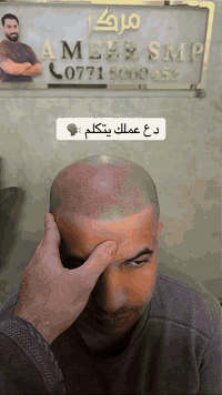 ⁨ ⁨ اخفاء فراغات الشعر ولصلع بتقنية SMP مركز امير SMP العنوان بغداد ار...