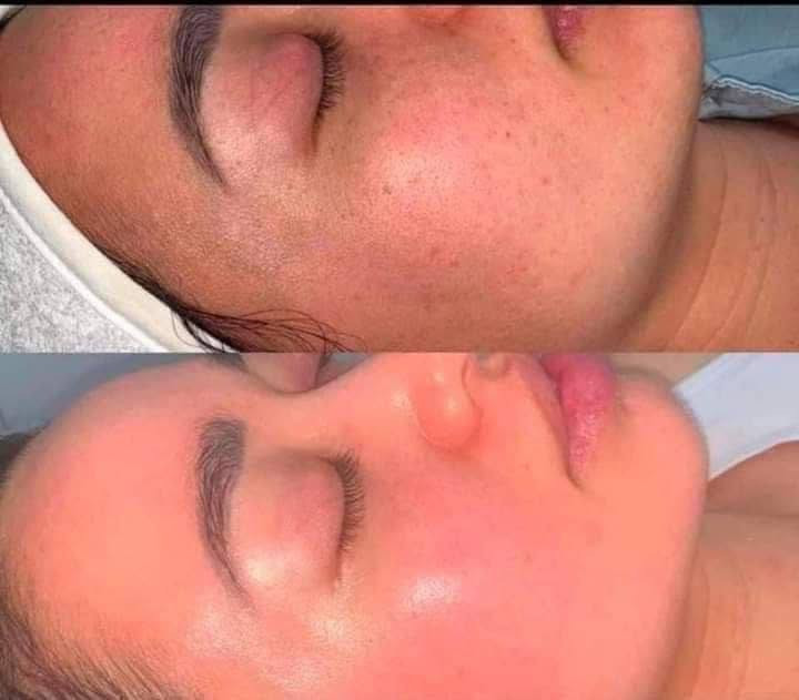 للحجز *********** أو خاص 
جهاز التقشير العميق للبشره جهاز التراسونيك سكن سكرابر Ultrasonic Skin Scrubber لتقشير البشرة العميق بالموجات فوق الصوتية ...
---------جهاز تقشير البشرة 
يعمل على ازالة الجلد الميت وعلاج التجاعيد والدهون والحبوب والحفر والبثور والترهلات وحب الشباب واثار حب الشباب كذلك تفتيح - تبييض - تحفيز افراز الكولاجين - تقشير سطحي بالالتراسونيك - تفتيت دهون البشرة يشد البشرة ويعيد لها نضارتها بالالتراسونيك - وعلاج الهالات السوداء - تجديد خلايا البشرة وشد البشرة
جهاز تنظيف وتقشير البشره #التراسونك 
شي عجيب شغله هذا الجهاز يزيل الرؤوس السوده ويقشر البشره بكل سهوله

Ultrasonc shovel
لتنظيف البشره العميق بتقنيه الموجات فوق الصوتيه
يعمل على تقشير وتنظيف الوجه بالموجات الفوق صوتيه (موجات التراسونيك عاليه التردد اي بذبذبات تلك الموجات يتم التنظيف العميق لها
يقوم بتنظيف عميق لبشره وجهك وازاله الزيوت منها (جيد للبشره الدهنيه ) وبالتالي ازاله الجلد الميت
وتحفيز لخلايا البشره وتخليصها من السموم والشوائب الضاره والعالقه بها
وكذالك تحفيز الكولاجين المسؤؤل عن نضاره البشره وشد البشرة

وقبل الاستخدام نقوم بتنضيف بشرتك من اي مكياج عالق به وابدئي بالتتقشير

السعر 13 الف عرض خاص
