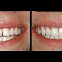 حشوات الأسنان الضوئية نحب نبلغكم إنو راح نكون متواجدين بعد العيد بإذن ...