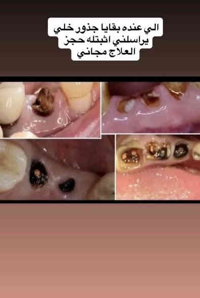 السلام عليكم 
تتوفر علاجات مجانية في عيادات جامعة البيان 🤎

وتكون للحالات التالية:

 •فحص الفم والأسنان.

 •تنظيف الأسنان وإزالة التكلسات والتصبغات.

 •قلع الأسنان التالفة وبقايا الجذور.

 •معالجة الأسنان بالحشوات التجميلية (الضوئية).

 •تعويض الأسنان المفقودة بطقم جزئي.

علماً أن العلاج مجاني بالكامل وبإشراف أطباء اختصاص✨

⭐️ملاحظة مهمة: الالتزام بالنظافة والتعقيم جزء أساسي للحفاظ على صحة الفم والأسنان.

📞 للتواصل /  لتحديد المواعيد  : على الرقم او الواتساب *********** 

📍 الموقع: عيادات جامعة البيان – شارع المطار – قرب ساحة عباس بن فرناس

مقدماً أهلاً وسهلاً بيكم 🌸✨
