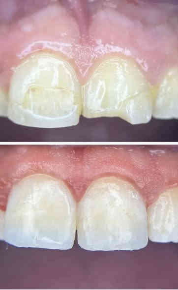 اعلااان🏅

السلام عليكم
بعد الانقطاع بسبب عطله الانتخابات
عياداتنه رجعت من جديد 
جاهزين لارجاع ابتساماتكم  والضحكه الحلوه على وجوهكم الجميله

وبشكل مجااااني

شنو الحالات الي نشتغلها؟
١-حشوات تجميليه ضوئيه
٢-تنظيف وازاله التكلسات والتصبغات
٣-قلع الاسنان التالفه او الجذور المتبقيه
٤-تعويض الاسنان المفقوده بطقم

موقعنا: كربلاء - حي الموظفين- خلف مشفى الولاده- عيادات جامعه كربلاء

زين انتو طلاب وجاي تطبقون بينه وتتعلمون مو صح!!

هاي جانب من شغل طلابنا شوف واحكم بنفسك.

للتواصل:***********
