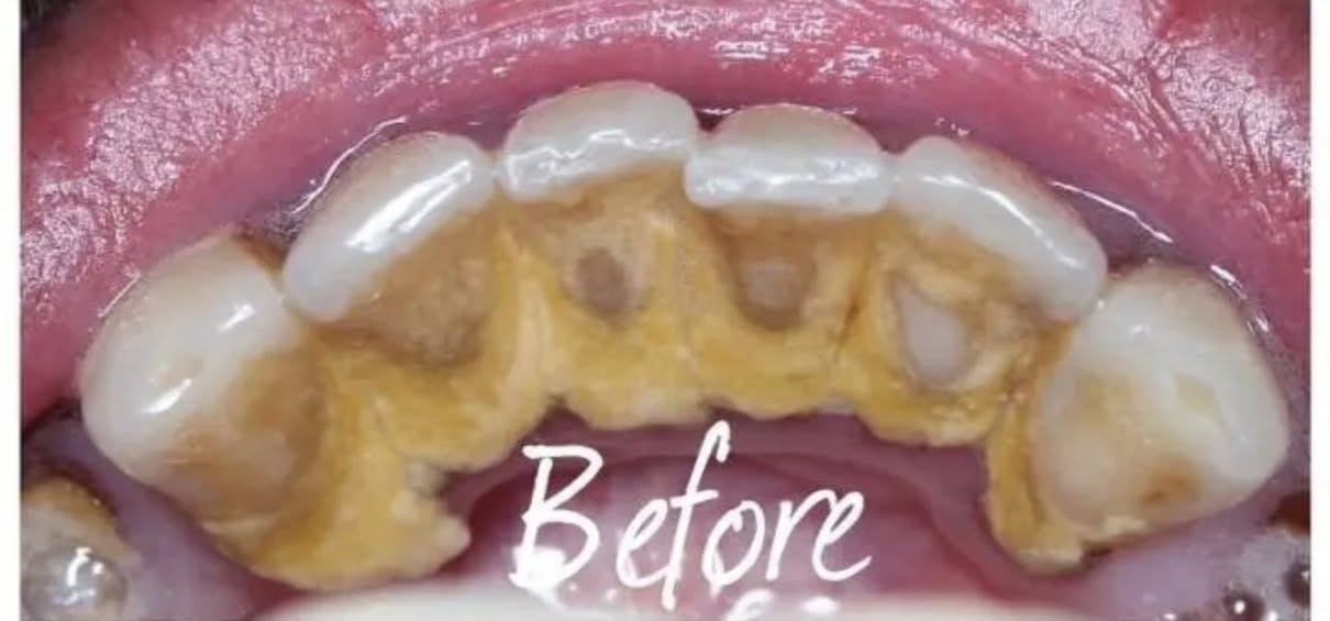 تنظيف اسنان مجاني للاسنان الي مثل الصور في البصرة والزبير للتواصل ***********
