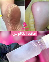 مادة كالوس • ازالة الجلد الميت • للقدمين