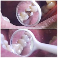 🦷💥 حشوة جذر بجلسة واحدة فقط! ما تحتاج تنتظر أو تمر بجلسات متعددة… الآن...