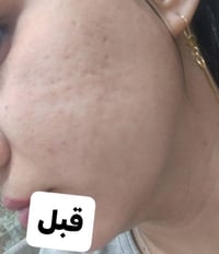 مسامات مفتوحة • باكج مسامات • قبل وبعد