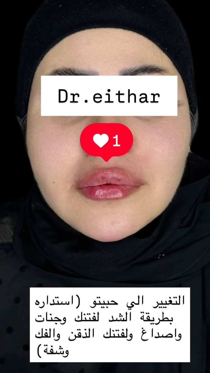 تجديد استداره وجه كامله بطريقة الشد بالفلر (لفتنك وجنات واصداغ  الفك والذقن  ونظاره  فلر شفة بالفلر الكوري)

عروض  خصم التغيير الشامل وجلسات الشد والنظاره    مستمره🔥🔥دزو نقطه توصلكم العروض

د.ايثار سامي عبد الامير
الكوت_واسط _الهوره_مجمع القبطان

الحجز***********
