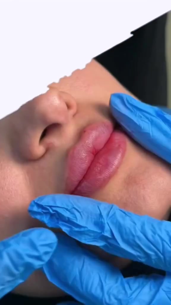 #التغير عند د.علا هادي الشمري 

6*********** ‏📞
💋💋💉
#explore #explorar #explorer #lip #lipfillersبدون برامج التعديل والفوتو 
  هذا هو الواحد سيسي هذا الحجم فقط مو اكثر من هيج
الرسم والكبس والرفع ونظافة الحقن هي الاهم من الحجم
دكتورة علا هادي الشمري  

#lip #lipfillers #explore #explorer

تابعوا
https://www.instagram.com/reel/DYcnOqPoN3O/?igsh=MTdyZDdvcHFqOHdzZQ==
@أبرز المعجبين
#دليل_التجميل_في_الكوت
