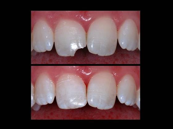 السلام عليكم اخواني
الي محتاج حشوات باسنانه الامامية بسبب كسر او تسوسات مثل الي بالصورة خل يراسلني او يعلق
*********** واتساب تلغرام
