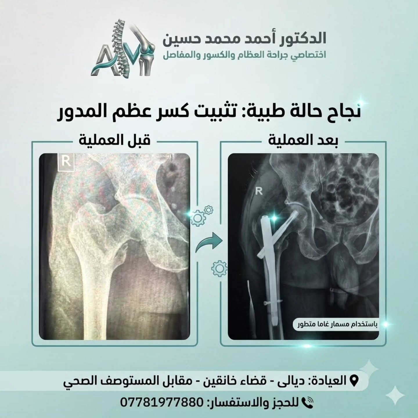 الدكتور احمد محمد حسين 
بورد في جراحة العظام والمفاصل والكسور 
للاستفسار على الرقم 📞 ***********
