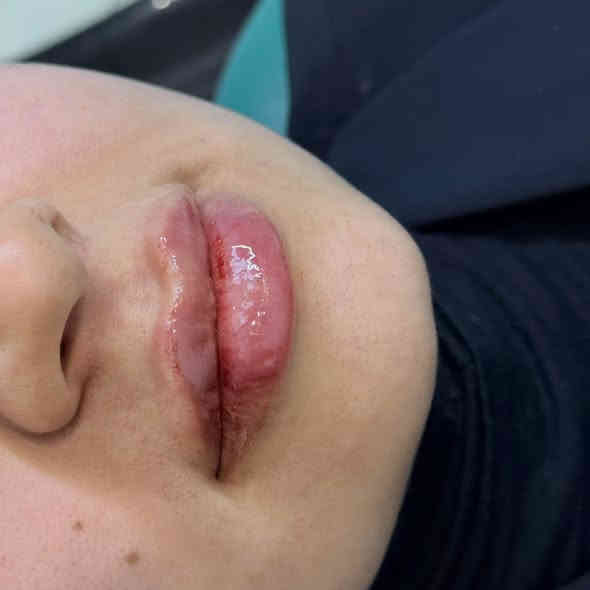 أذابه فلر محقون بطريقه غلط  متكتل وصاعد ع منطقه الشارب وتجديد الحقن❤️‍🔥😍 +اسحبو جان تشوفون باقي الجمال 🔥 المسيب *********** 

#فلر_شفايف #فلرشفة_فلر_وجنات_فلرخطوط_ضاحكة_فلرذقن_تكساس_تكنيك❤️❤️❤️ #الشعب_الصيني_ماله_حل😂😂
