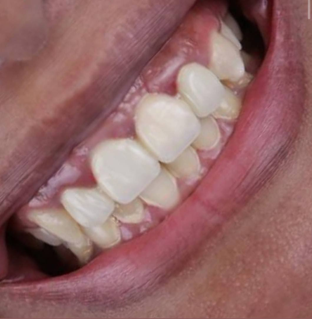 إذا جنت مأجل خطوة الزراعة ومتخوف من الألم أو الوقت، نحب نطمنك إن التقنيات الحديثة خلت الإجراء أسهل، أسرع، وبدون ألم يذكر.
العمر يفوت.. وصحتك وراحتك تستاهل الخطوة 

لا تخلي الفراغات تاخذ من ضحكتك، عيادتنا تفتحلك الباب لترجع ابتسامتك كاملة ومشرقة مثل الأول وأحلى.
إذا جنت مأجل خطوة الزراعة ومتخوف من الألم أو الوقت، نحب نطمنك إن التقنيات الحديثة خلت الإجراء أسهل أسرع  وبدون ألم يذكر.
للأستشارات والفحص مجاناً
وتساب *********** 
​#زراعة_الأسنان #ابتسامتك_تستاهل #طب_الأسنان #ثقة_وابتسامة #صحة_الفم

