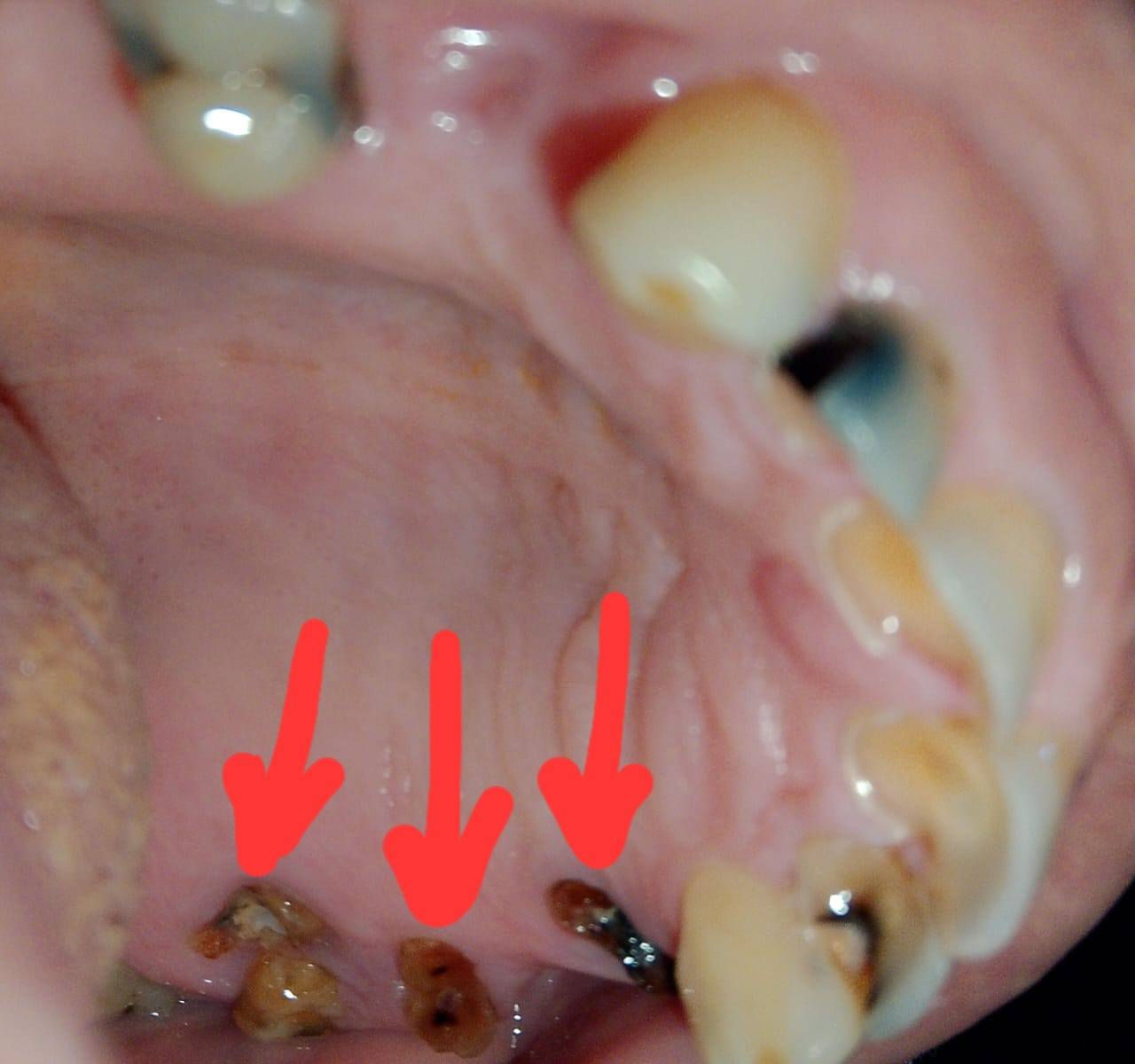 السلام عليكم ورحمة الله وبركاته
الي عنده مثل هاي التكلسات والجذور المتبقية ويحتاج تنظيف او قلع يتواصل ويانه ع هذا الرقم *********** العلاج مجاني بإشراف اطباء اختصاص وننطيكم كروتكم العنوان بغداد باب معظم
