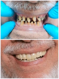 تركيب زركون • مجمع اليمامه • خبرة ٢٢ سنة