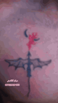 مركز گلگامش • ازالة الوشم • الرمادي التاميم