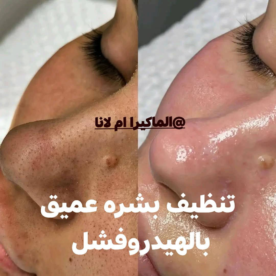 عروض عيد الفطر المبارك  🌙من Goldn touch للتجميل 🌙

مكياج 20الف فقط تسريحة 20الف🌙 حنه او عرس مع جميع الإضافات 150😍

بكج 100 الف 
صبغ +تخصيل+ قص+معالج + سشوار للشعر القصير والمتوسط 

بكج 25
حف +تنظيف بشرة عميق

رموش كامله  25الف 
طرفيه 15الف
حفافه +شمع 15الف فقط
حفافه 10 الف
تنظيف بشرة بجهاز الهايدروفيشل 25 
لـكل جـمآل عـنـوآن ونـحـن صـنآع آلـجـمال🧷✂❤️

 العرض الاول :::💄

سحب لون + صبغ شعر قصير+قص ومعالج =75الف  ❤
سحب لون +صبغ شعر متوسط+قص ومعالج =100الف ❤
سحب لون + صبغ شعر طويل+قص ومعالج 125الف❤

العرض الثاني:::💄

صبغ شعر + تخصيل + قص ومععالج للشعر القصير =100الف❤
صبغ شعر + تخصيل + قص ومعالج للشعر المتوسط = 125الف
صبغ شعر + تخصيل+ معالج وقص  للشعر الطويل 150 الف
❤

 *قص & شسوار & تريتمنت =25 الف بس ❤

عروض المعالج والمسرح ❤💛❤

العرض الرابع :::💄
معالج + مسرح للشعر القصير = 90الف 💚
معالج + مسرح للشعر المتوسط = 125الف ❤
معالج + مسرح للشعر الطويل يحدد السعر بعد المعاينه 💚
يغسل نفس اليوم 

#عروض التاتو ❤

تاتو 6D سعر الجلسة =50❤
تاتو فايبرز سعر الجلسة =90❤
تاتو بلوك سعر الجلسة =65الف ❤
تاتو مايكرو سعر الجلسة =65الف❤

توريد الشفه الجلسة الواحدة = 50💚💜💚 
💗تحديد  الشفه  سعر الجلسة الواحدة =50 الف ❤💚

عروض الوشم 🖋🦋
يبدأ سعر الوشمة من 15 الف الى 50الف حسب حجم الوشمة 🦋

 
كوكيز 40خصله 250 فقط😍

 

📍العنوان: بابل شارع٤٠ /القاضيه/ فرع بيت العطر/ صالون Golden touch 
الماكيرا ام لانا 

☎️ للاستفسار والحجز الاتصال على الرقم التالي:***********
