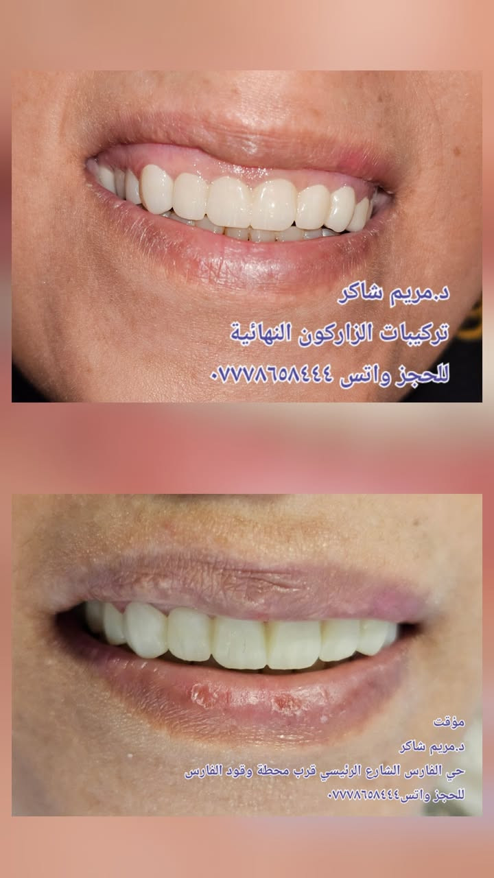 عمل حشوات الجذور للاسنان وبناء الاسنان وتغليفها بتركيبات الزاركون الثابتة وتعويض الاسنان المفقودة 
حي الفارس الشارع الرئيسي قرب محطة وقود الفارس 
د.مريم شاكر 
للحجز واتس ***********
يتوفر خصم ٤٠ بالمية 
يتوفر خصومات للعوائل ذات الدخل المحدود #قلع #حشوات#حشوات جذور #تركيبات ثابتة ومتحركة #زراعة اسنان #تقويم اسنان
