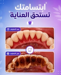 تنظيف الأسنان • إزالة الترسبات • الحلة