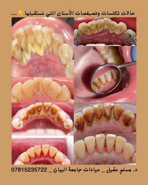 🔹️يسعدني استقبالكم في عيادات كلية طب الأسنان _ جامعة البيان _ شارع مطار بغداد الدولي – قرب ساحة عباس بن فرناس ...

🔹️العلاج بإشراف أساتذة مختصين وبعلاج مجاني بالكامل 💙🦷...

🔹️أسنانكم أمانة... وابتسامتكم مسؤوليتنا 💫
نقدّم رعاية شاملة لجميع الحالات، مع متابعة دقيقة لضمان أفضل النتائج...

🔹️الحالات التي نستقبلها :
• تنظيف وإزالة التكلسات والتصبغات.
• فحص شامل للأسنان وتقييم اللثة.
• إزالة التسوسات وحشوات ضوئية وبلاتينية.
• قلع الأسنان الأمامية والخلفية والجذور التالفة.
• عمل أطقم جزئية متحركة لتعويض الأسنان المفقودة.
• متابعة دورية للحالات لضمان استقرار النتائج.

🔹️للحجز والاستفسار 📩:
• واتساب: ***********
• إنستغرام: dent.muslim1
• تلغرام: @Dr_Muslim45

#العراق #بغداد #عيادات_جامعة_البيان #ابتسامتك_مسؤوليتنا #تنظيف_أسنان #حشوات_ضوئية #ابتسامة_صحية #مجاني #Baghdad #Iraq #طب_الأسنان #DentalCare #Smile #TeethCleaning #عيادات_مجانية #اكسبلورر #لايك
