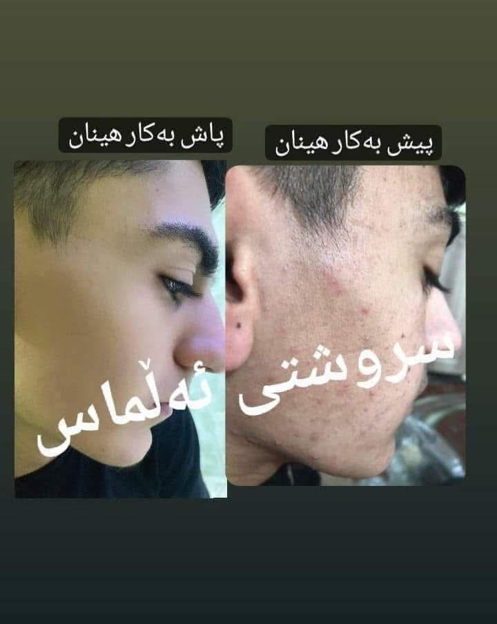 تۆش بەدەست کێشەکانی پێستەوە دەناڵێنی نازانی چی لێبکەیت و بەچی چارەسەری بکەیت🤔
کرێمێکت دەوێت بەگرەنتی👌 پارەگەڕانەوە ئەگەر سوودی نەبوو لەماوەی تەنها 🔺١٥ڕۆژدا
🟡سێتی کرێمی ئەمەریکی ئەڵلماس کەخاوەنی کوالێتی کۆنترۆڵە ☑️
ئەوەی ئەم کرێمەی بەکارهێناوە بۆهەمیشەیی ماڵئاوای لەتەواوی کێشەکانی ڕوخساری کردوە و دەوروبەری داوای ئەم کرێمەیان لێکردوە بەهۆی سوودو گۆڕانکاریە زۆرەکەیەوە 👍
ئەم کرێمە چارەسەری تەواوی ئەم کێشانەی ڕوخسارت بۆدەکات بەگرەنتیەوە 
🔺لابردنی زیپکەو شوێنەواری زیپکە
🔺لابردنیی پەڵەی سەرپێست و ژێرپێست
🔺لابردنی ڕەشی ژێرچاوو یەک ڕەنگ کردنی روخسار بەتەواوی
🔺لابردنی سوتاوی بەرخۆرو نەرم کردن و سافکردنی دەماوجاوو بەگشتی یەک ڕەنگردنی 
🟡کارتی گرەنتی و زەمانی بەکارهێنانی لەگەڵدایە سوودی تەواوت وەرنەگرت قەرەبوی تەواو دەکرێیتەوە 
بۆداواکردن و زانیاری زیاتر پەیوەندی بەم ژمارەیەوەبکەن
🚕گەیاندنمان بەردەستە 
📞***********
