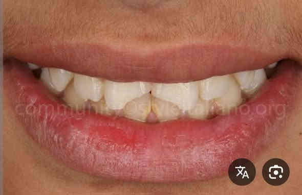 السلام عليكم الي محتاج حشوات مجانيه
مثل هيج حالات اتصال  على ***********
