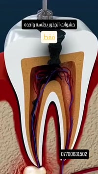 حشو جذور • جلسة واحدة • كربلاء