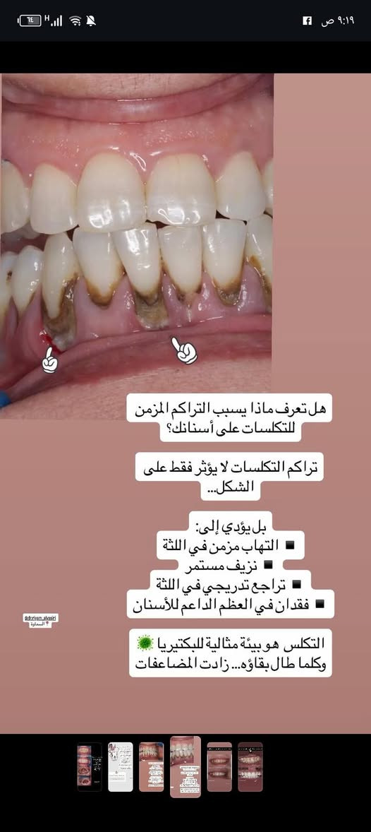 ✨ لأن صحتك وجمالك يستاهلون الأفضل ✨
تقدم لكم عيادة [الضياء سمايل]
أفضل الخدمات الطبية والتجميلية بأحدث الأجهزة وعلى أيدي مختصين 💉🌸
✔️ استشارات طبية دقيقة
✔️ جلسات تجميل وعناية بالأسنان
✔️ نتائج مضمونة واهتمام بأدق التفاصيل
📍 الموقع: [السماوه حي المعلمين مقابل نيكست لفل]
📞 للحجز والاستفسار: [***********]
💖 راحتك وثقتك بين إيدينا 💖

https://www.instagram.com/dr.riyam_alyasiri?igsh=N2xva2FtOHNpNXpi
