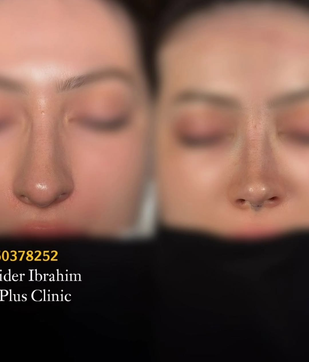 ✨ تجميل أنف أنثوي برسمة متناسقة تناسب ملامح الوجه ✨

نتائج طبيعية ولمسة جمالية تحافظ على تناسق الوجه، مع تصميم يناسب ملامح كل حالة بشكل فردي للحصول على مظهر أنثوي ناعم وجذاب.

👨‍⚕️ الدكتور حيدر إبراهيم 📍 متواجد يوميًا لاستقبال المعاينات والحجوزات. 📞 ***********

#تجميل_الأنف #رأب_الأنف #أنف_أنثوي #تجميل #نتائج_طبيعية جراحة_تجميل الدكتور_حيدر_إبراهيم بغداد العراق
