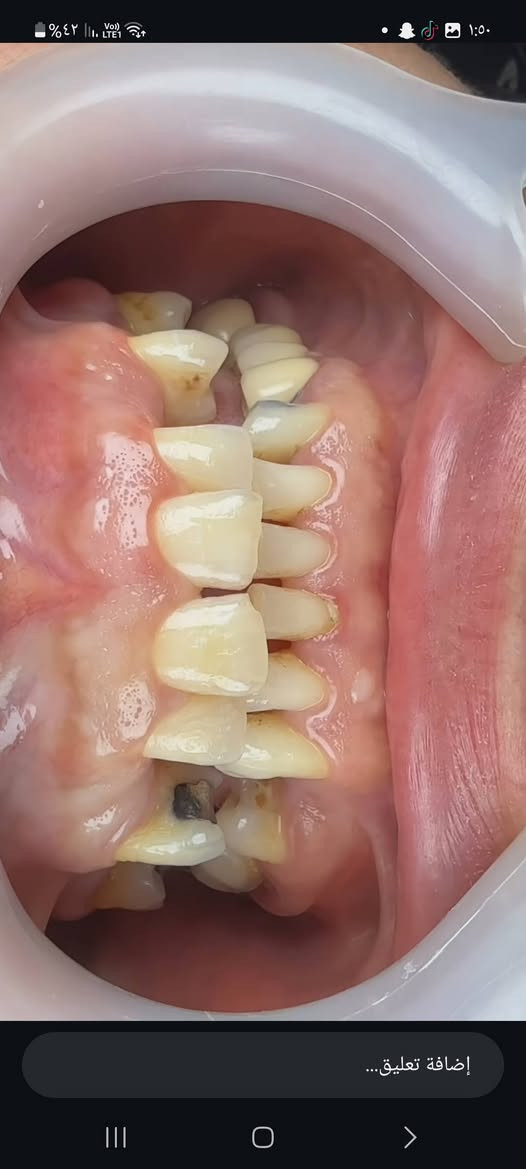 ابتسامتك تستحق الأفضل ✨🦷
إذا تبحثون عن ابتسامة أجمل وصحة أفضل لأسنانكم 🤍
نستقبلكم في عيادة الدكتور شاكر أحمد شاكر لتقديم خدمات طب وتجميل الأسنان 🦷✨
📸 نماذج من أعمال العيادة 👇🏻
نهتم بالتفاصيل حتى تحصلون على ابتسامة تليق بكم 🤍
📍 العنوان: قرب جسر ديالى القديم
📞 للحجز والاستفسار: ***********
✨ للحجز والاستفسار تواصلوا معنا ✨
#عيادة_الدكتور_شاكر_أحمد_شاكر
#طب_وتجميل_الأسنان
#تجميل_الأسنان
#ابتسامة_جميلة
#الزعفرانية
