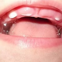 تسنين رضع • أغذية بالكالسيوم • عضاضة مبردة