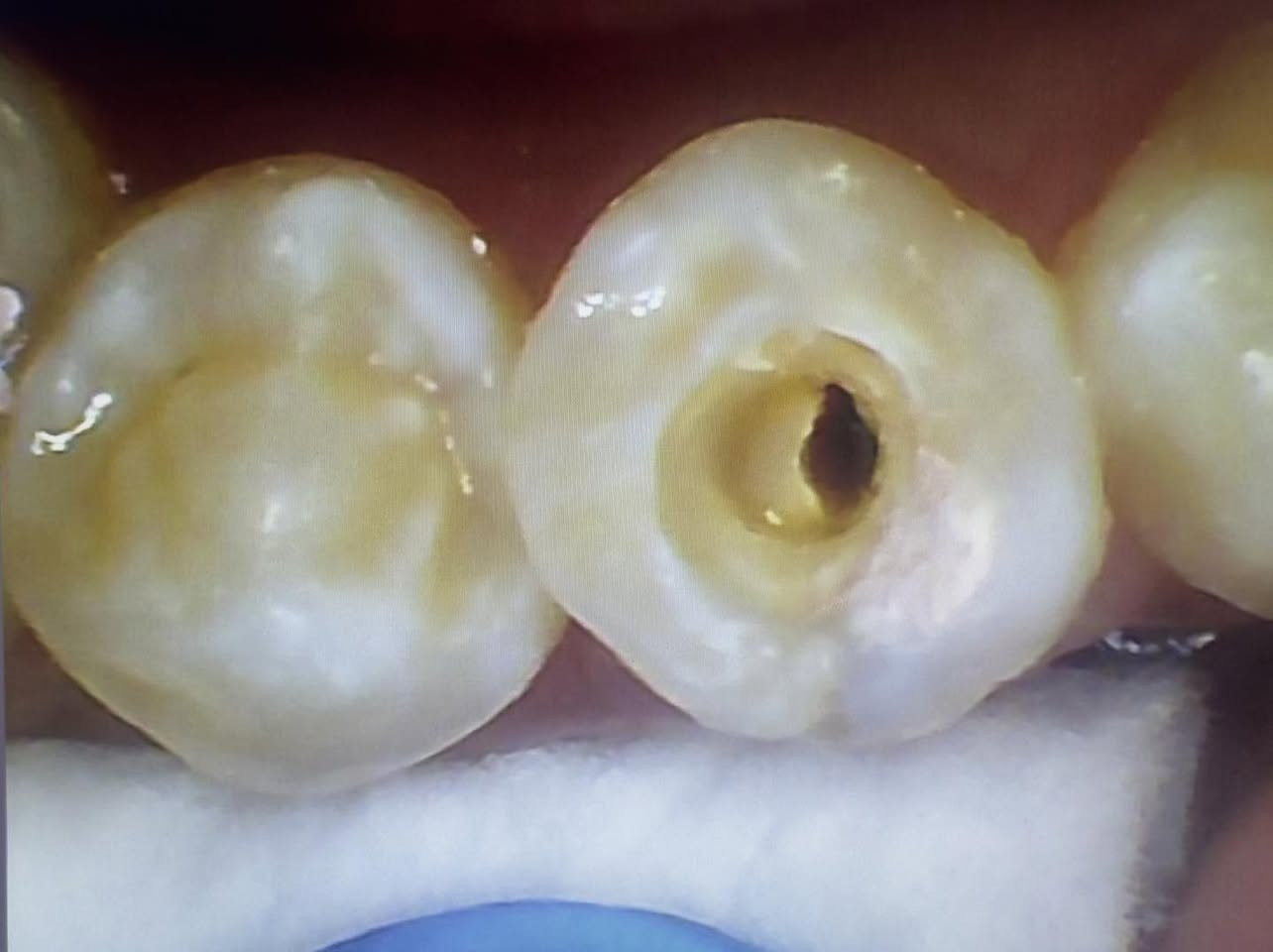 حشوة جذر للسن الخلفي
طبيب الاسنان الاختصاص د.عمار عباس
ماجستير تقويم وتجميل الاسنان M.S.c ortho
بكلوريوس طب وجراحة الفم والأسنان B.D.S
بغداد الشعب شارع عدن قرب  مركز شرطة الشعب  مدخل سوق شلال عمارة باريس الطابق الاول دوام العيادة جميع ايام الاسبوع ما عدا الجمعة عطلة من ٤ ل ٨  بدون حجز مسبق الدخول حسب اسبقية الحضور للعيادة الفحص والمعاينة مجاني للاستفسار ***********
