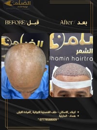 زراعة شعر • كثافة عالية • ضمان مدى الحياة