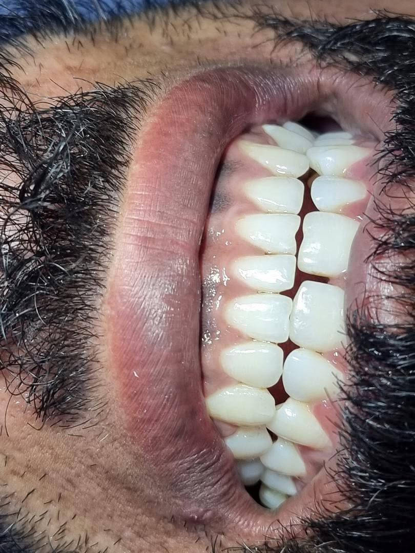 ابتسامتك تبدأ من أسنان نظيفة وصحية ✨

تنظيف الأسنان بشكل دوري يساعد على إزالة الترسبات والجير، ويحافظ على صحة اللثة ويمنحك نفسًا منعشًا وابتسامة أجمل. 🦷💙

#عيادة_كوثى_لطب_وتجميل_الاسنان
#الدكتور_علي_حسن_العزاوي 
جبله/نهاية شارع الاطباء
مقابيل الدكتوره ميثاق المعموري

***********//للاستفسار
