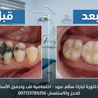 استبدال الحشوات القديمة☑️☑️✅️☑️ عنوان العيادة 🏢🏢 نفس جهة بسماية  الشار...