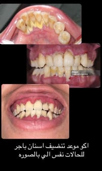 الي محتاج تنظيف لاسنانة وعندة تصبغات وتكلسات يراسلني باجر الموعد 07728...