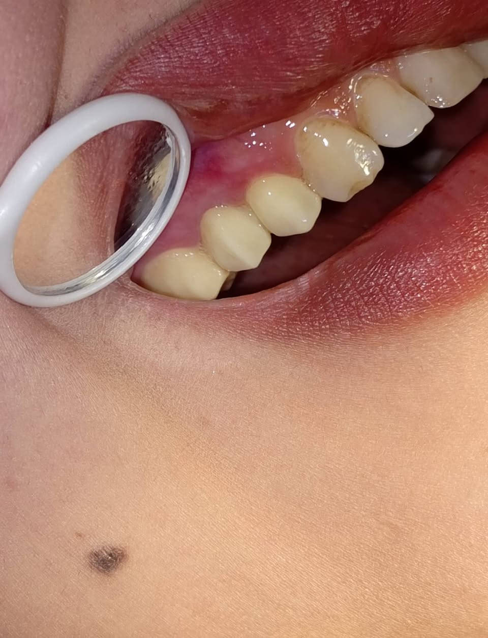 ابتسامة  ساحره وثقة مضاعفه 🩵🔥 عيادتنا فرع حي النصر 🔥🔥

تعويض الاسنان باستخدام (جسر زاركون ألماني) لمراجعتنا 
وتم تعويضها ب اسنان
- الزاركون  الدائمي( الألماني) 
على يد الطبيب الاختصاص
د.محمد منصور 
(ماجستير في طب ومعالجة الاسنان) 

أبتسامتك ~ يم عيادات الفرح لطب وتجميل الأسنان ~ غير ✨😍

علماً كافة الابتسامات والحشوات مع ضمان مدى الحياة 😎

للإتصال 📞📞 
فرع حي النصر
#العنوان
حي النصر/ شارع الاطباء / قرب جامع الأمام المهدي
فوق صيدلية مصطفى جاسم أو أسواق الزعيم 
للحجز والاستفسار 
*********** ☎️

دوام العياده ⏰
فرع حي النصر 
من الساعه 5  عصرا 
إلى 
الساعه 10 مساءا
