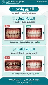 مجمع السياب الطبي • تركيب أسنان • ابتسامة هوليود