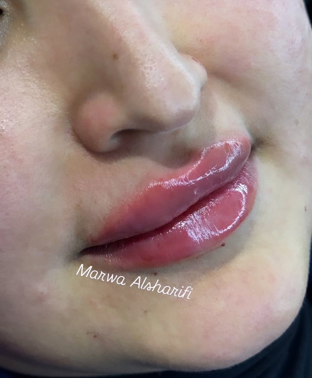 جمال المراجعة حبت تحقن فلر شفه الرجس ونضارة للبشرة من ايد مروة الشريفي😍


**إذا كنت صاحب هذا الإعلان وتريد حذفه لأي سبب، رجاءا أرسل رسالة إلى الدعم الفني**