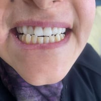 ابتسامه هوليوود بسعرتنافسي للتواصل واتساب 07873705688
