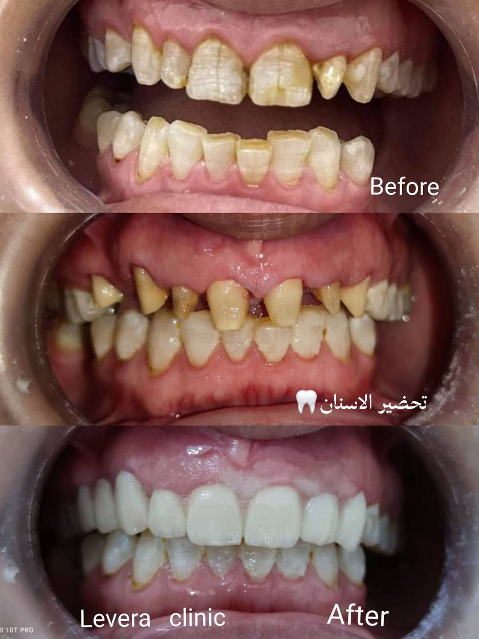 عيادة ليڤيرا لطب وتجميل الاسنان 
   نستقبلكم يوميا من الساعة 3 مساءً إلى 8 مساءٌ 
  أبتسامات عالية الجودة ضمان بالعمل 
    متابعة دورية بعد الانتهاء من العمل 

للحجز والاستفسار ***********
   أو زورو العيادة 
العنوان الناصرية-حي أريدو شارع مستشفى القلب مجاور الصيدلية النموذجية 

#أبتسامات #تركيب_اسنان #عيادةاسنان #حي_أريدو #الناصرية #أبتسامة_دايركت_فينيير #أبتسامة_هووليود
