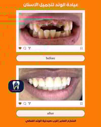تركيبات اسنان • عيادة الوتد • الشارع العام