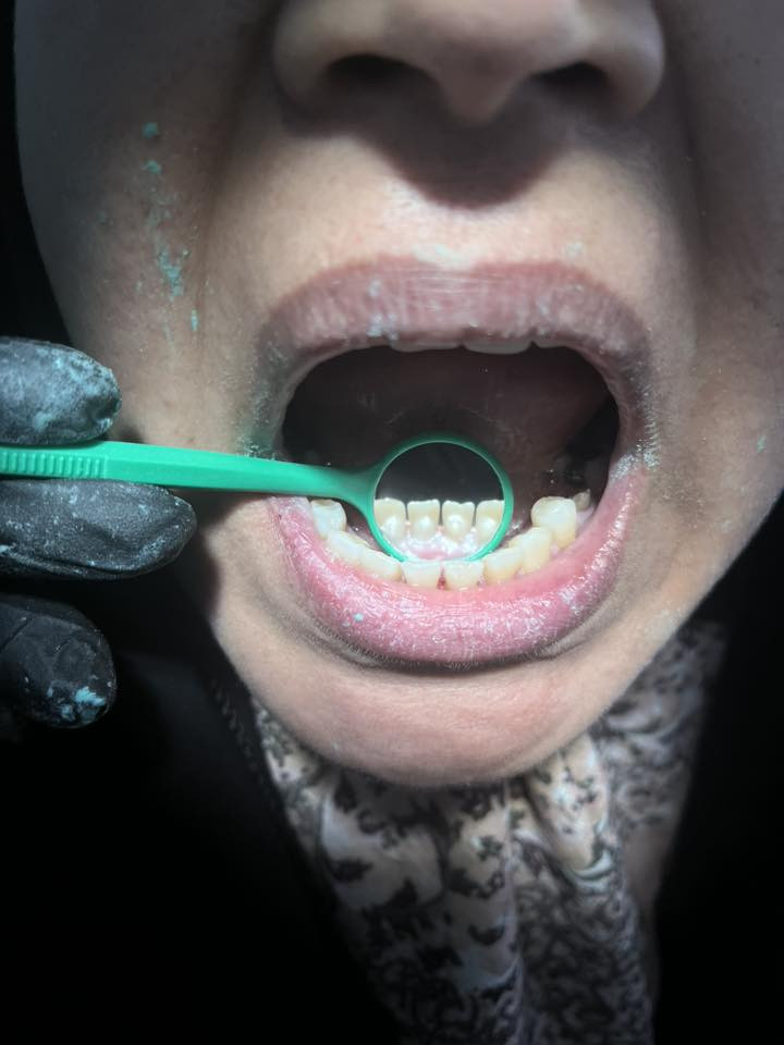 السلام عليكم
منو عنده تسوّس او كسر بأسنانه الامامية وزاعجه منظرهم
اشتغلهن الكم حشوات ضوئية مجاناً
واذا عدكم تكلسات وحابين تسوون تنظيف💙


**إذا كنت صاحب هذا الإعلان وتريد حذفه لأي سبب، رجاءا أرسل رسالة إلى الدعم الفني**