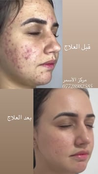 صباح الخير عروض عيد الغدير يعلن سنتر الاسمر لتجميل عن عروض وصل ب١٠ آلا...