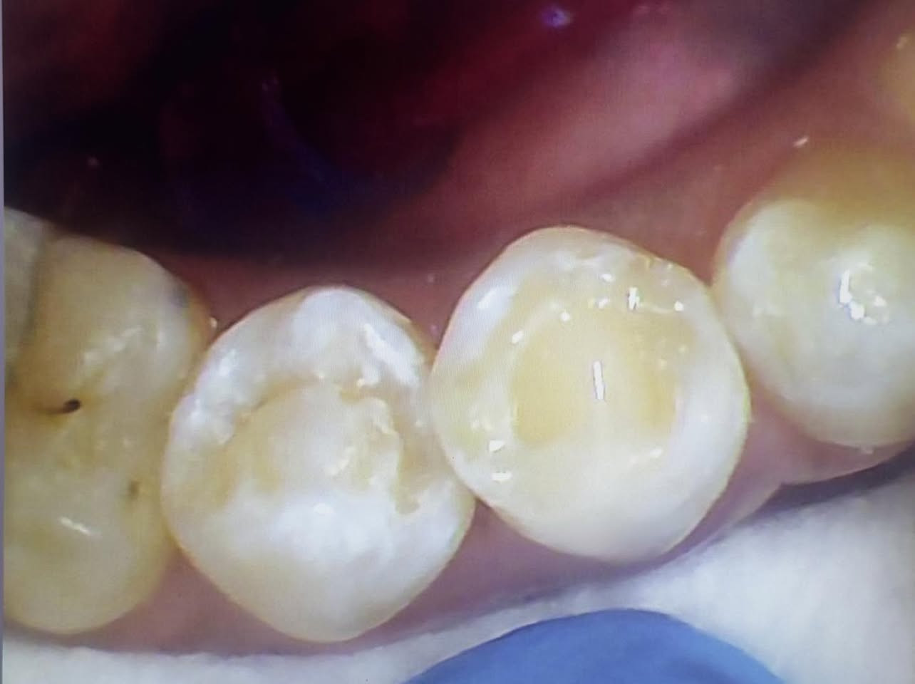 حشوة جذر للسن الخلفي
طبيب الاسنان الاختصاص د.عمار عباس
ماجستير تقويم وتجميل الاسنان M.S.c ortho
بكلوريوس طب وجراحة الفم والأسنان B.D.S
بغداد الشعب شارع عدن قرب  مركز شرطة الشعب  مدخل سوق شلال عمارة باريس الطابق الاول دوام العيادة جميع ايام الاسبوع ما عدا الجمعة عطلة من ٤ ل ٨  بدون حجز مسبق الدخول حسب اسبقية الحضور للعيادة الفحص والمعاينة مجاني للاستفسار ***********
