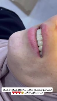 فرحتي تكمل بفرحتكم 🥹❤️❤️  ابتسامه وتعريض اسنان لمراجعتنا ❤️❤️❤️  للحجز...