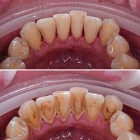تنظيف اسنان • علاج مجاني • كربلاء