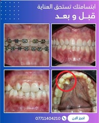 تقويم أسنان • تراكب أسنان • الحلة