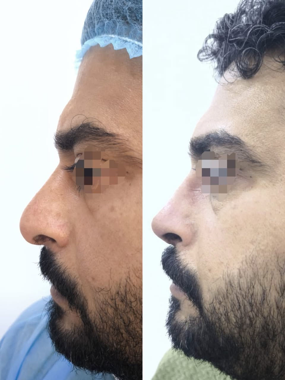 ✨ وداعاً للانحراف.. واستمتع بجمال التماثل الطبيعي! ✨
​هل تعاني من ميلان واضح في جسر الأنف أو تشوه ناتج عن كسر سابق؟ الحل الآن أصبح أسهل وأقرب إليك مما تتخيل!
​الحالة المعروضة في الصور:
​قبل العملية (الجهة اليمنى): يظهر بوضوح ميلان وانحراف في محور الأنف ناتج عن كسر سابق، مما أثر على تناسق ملامح الوجه.
​بعد العملية (الجهة اليسرى): استقامة تامة وشاقولية لمحور الأنف، مع رسمة طبيعية تتناسب تماماً مع تقاسيم الوجه.
​لماذا تختار عيادتنا؟
​نحن نحول التحديات الجمالية والوظيفية إلى نتائج واقعية ومثالية:
✅ تعديل الانحراف والكسور بدقة متناهية.
✅ تخدير موضعي (بدون الحاجة للتخدير العام ومخاطره).
✅ إجراء آمن وسريع وبأحدث التقنيات الجراحية.
​💰 عرض خاص لفترة محدودة:
​احصل على الأنف المثالي الذي طالما حلمت به فقط بـ 600,000 دينار عراقي! 🇮🇶
​📍 العنوان: [الشطرة ـ حي المعلمين ـ مركز ااشرق الأوسط]
📞 للحجز والاستفسار: [‏078-132-88144‏
​نحن نرسم الجمال.. لنعيد إليك الثقة!
​#تجميل_الأنف #تعديل_انحراف_الأنف #تجميل #عراق #بغداد #تخدير_موضعي #جمال #ثقة #عمليات_تجميل #قبل_وبعد
