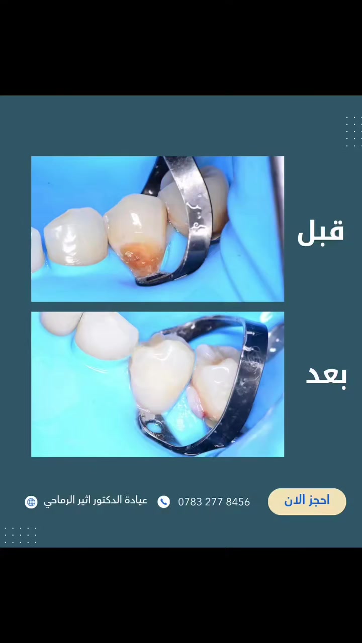 "حشوة تجميلية للأسنان الخلفية 🦷✨
تم إزالة التسوس بدقة وإعادة بناء السن بحشوة تجميلية تحافظ على الشكل الطبيعي والقوة الوظيفية.
✅النتيجة: سن نظيف، متماسك، ومظهر طبيعي بدون أي فرق عن الأسنان الأصلية."

☎️للحجز والاستفسار ***********

📍الموقع : 
الديوانية- قضاء عفك/شارع الأطباء قرب صيدلية أكرم البديري بناية الدكتورة مروة حمود التميمي الطابق الثاني

​#دكتور_أثير_الرماحي #تجميل_الأسنان #حشوات_تجميلية #طب_أسنان_العراق #قبل_وبعد.
