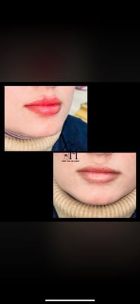 فيلر شفه • تعديل رسمه • العروبة